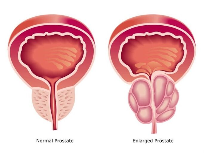 Prostovit normalise le travail et la taille de la prostate