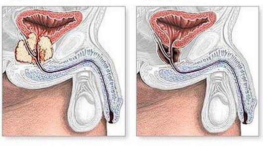 Chirurgical avant et après le traitement de la prostatite chronique