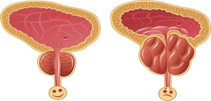 prostate saine et enflammée