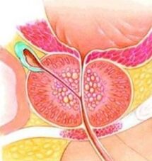 Prostate -adénom