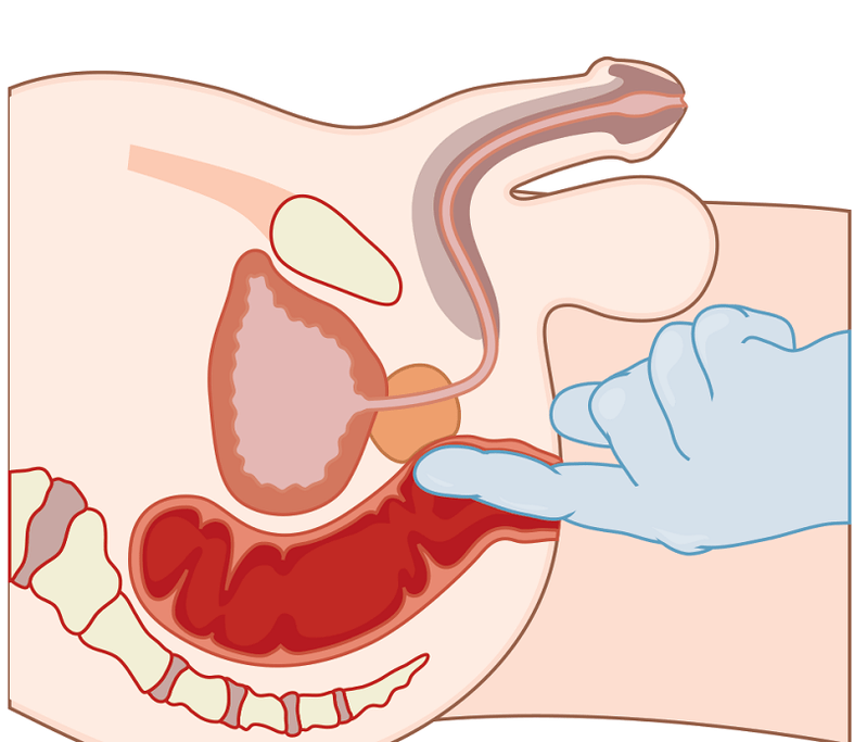 Massage de la prostate avec prostatite